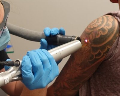 Removery-Tattoo-Removal-Fading-min
